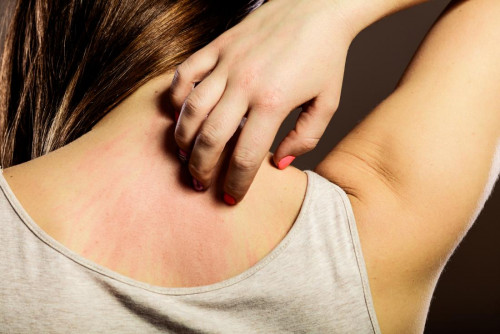 woman-scratching-her-neck